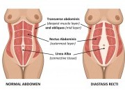 Os abdominais hipopressivos e a diástase